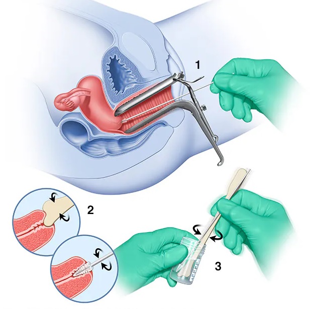 آزمایش پاپ اسمیر