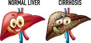 علل شایع سیروز کبدی