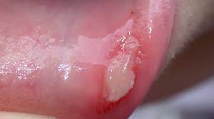 بیماری بهجت